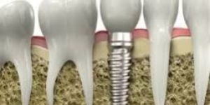 Titanium Dental Implant