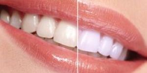 Tooth Whiteners