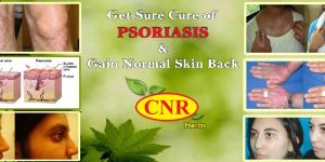 C N Rajadurai Psoriasis Treatment