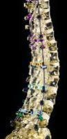 Spinal Implants