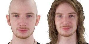 Wig for Alopecia Patients