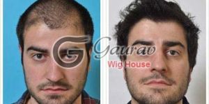 Hair Replacement System