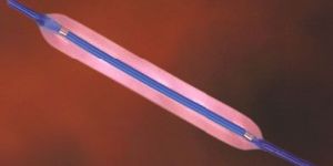 Ureteral Balloon Dilator