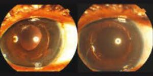 Posterior Chamber Lenses