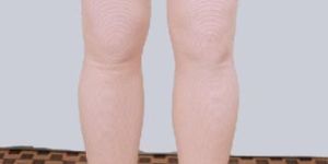 Varicose Vein Stockings