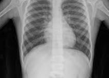 Spent X Ray & Hypo Fixer Solution Silver Recycling Services