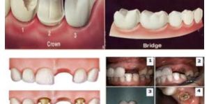 Fixed Crown & Bridges