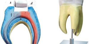 Upper Triple Root Molar With Caries