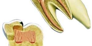 Upper Triple Root Molar With Caries