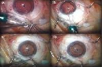 Foldable Intraocular Lenses