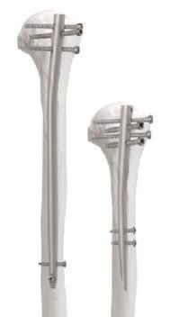 Humerus Nail