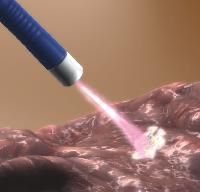 Argon Plasma Coagulators