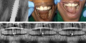 Dental Implants