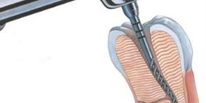 Coltene Endo Dental Products