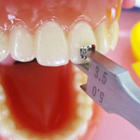 Dental Bracket