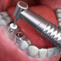 Surgical Stent