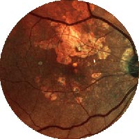 Retina Treatment Services