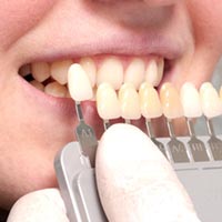 Cavity Filling Materials