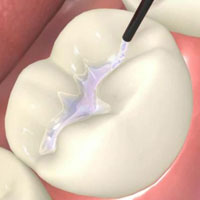 Dental Sealants
