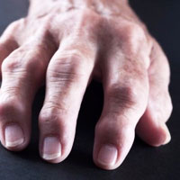 Rheumatoid Arthritis Drugs