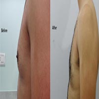 Gynecomastia Surgery
