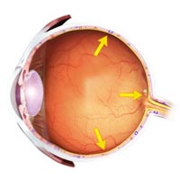 Glaucoma Surgery