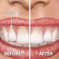 Cosmetic Gum Surgery
