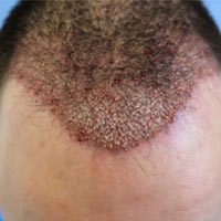 Follicular Hair Transplant