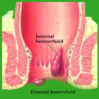 Piles Treatment Services