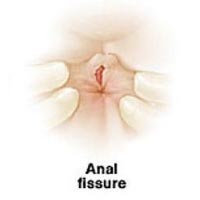 Fissures Treatment