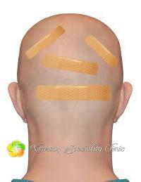 Fue Hair Transplant Service