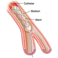 Coronary Stents