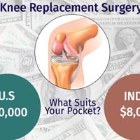 Knee Replacement Surgery