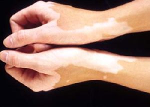 Leucoderma Treatment Services