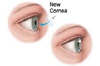 Cornea Services