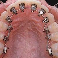 Lingual Braces