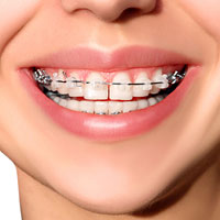 Dental Brace