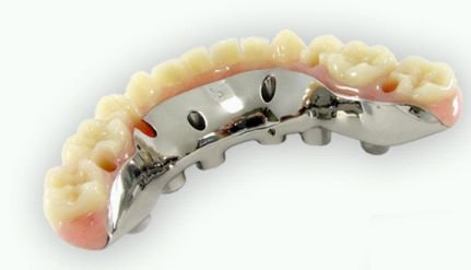 Dental Implant Hybrid Restorations 01