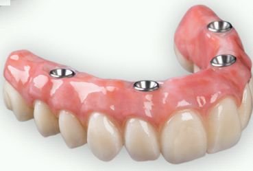 Dental Implant Hybrid Restorations 02