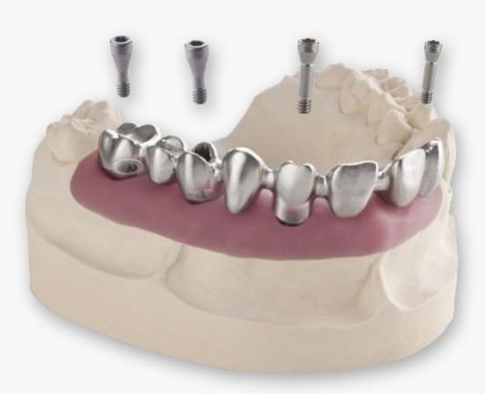 Dental Implants 03