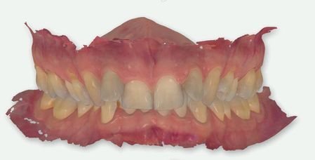 Digital Crown & Bridges 02