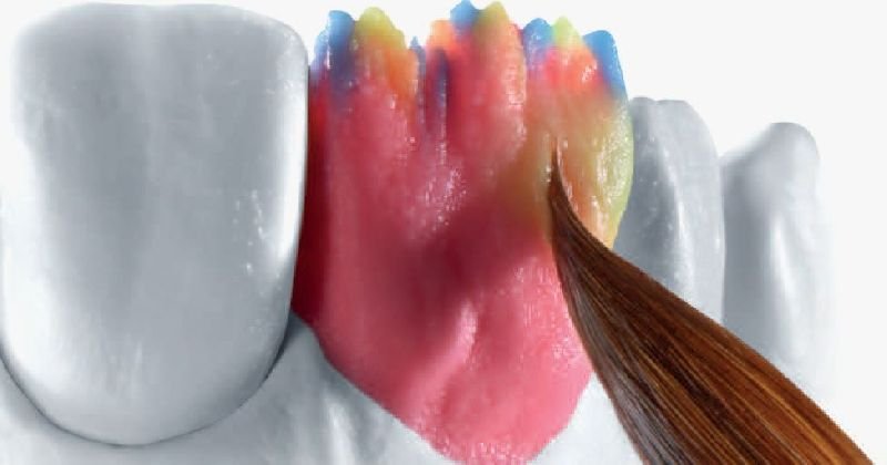 IPS e.max Ceramic Restorations 01