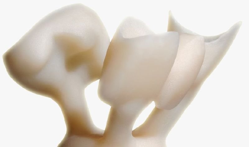 IPS e.max Ceramic Restorations 02