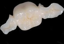 IPS e.max Ceramic Restorations 03