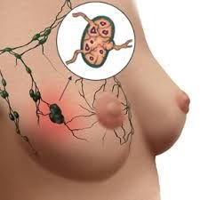 D Breast Cancer