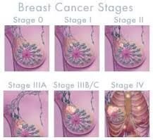 H Breast Cancer