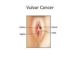 FEMALE CANCER - F