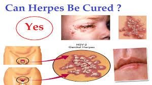HERPES - E