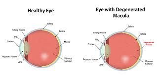 Macular Degeneration C