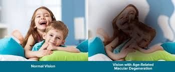 Macular Degeneration E